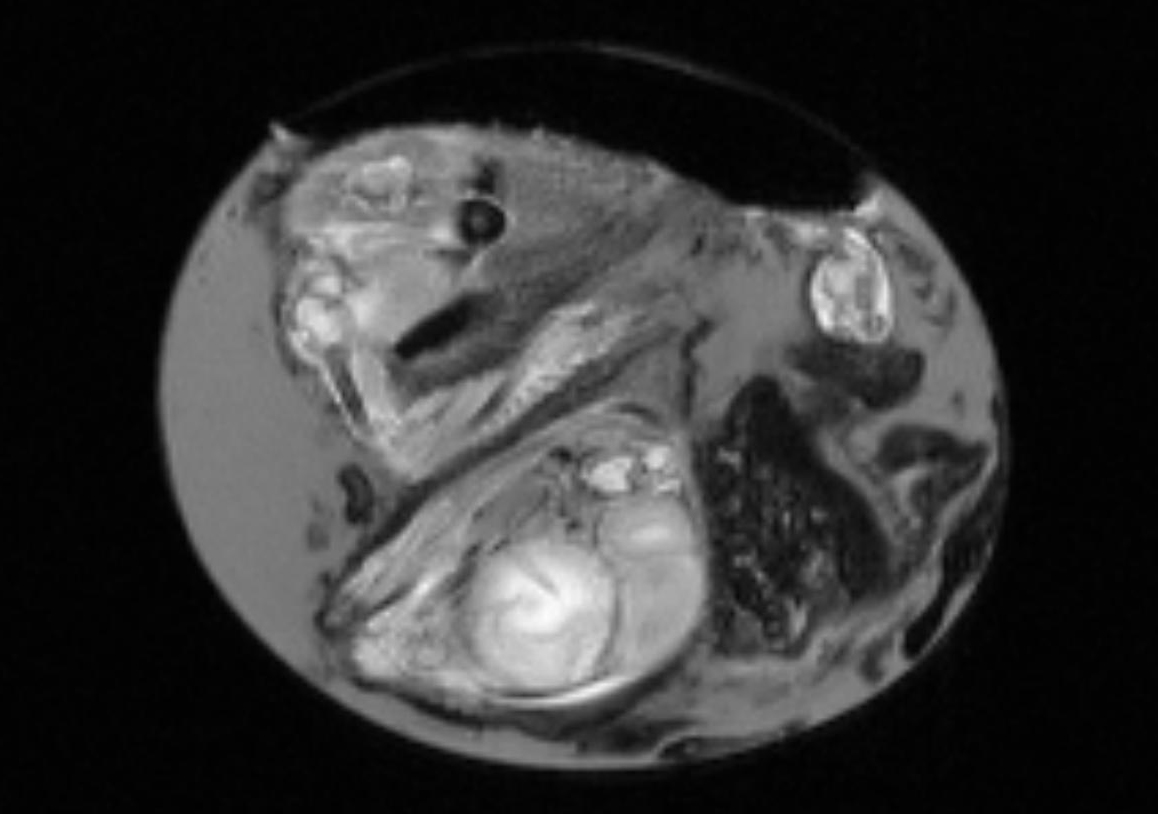 MRI jajo